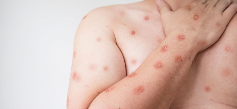 <p>Secretaria de Sa&uacute;de destaca cuidados preventivos &agrave; doen&ccedil;a Mpox</p>
